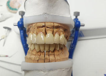Prothèse dentaire 