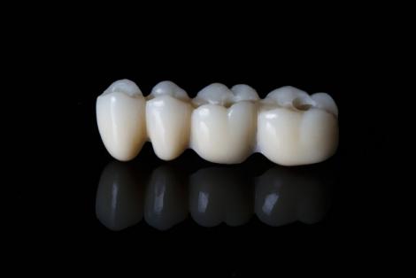 Prothèses fixes sur implants dentaires